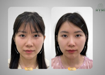 Giải Mã Lão Hóa Da và Phương Pháp Nâng Cơ Hiệu Quả  từ Hymi Prime